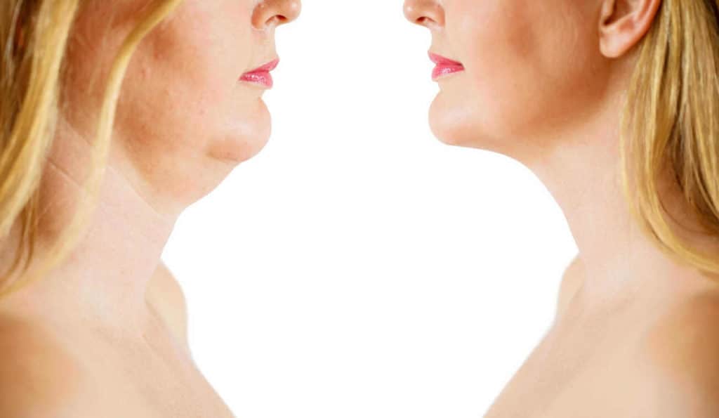 Double Chin treatment Norbiton before and after results