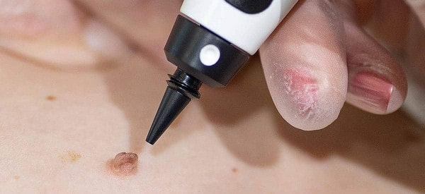 After Skin Tag Removal Norbiton