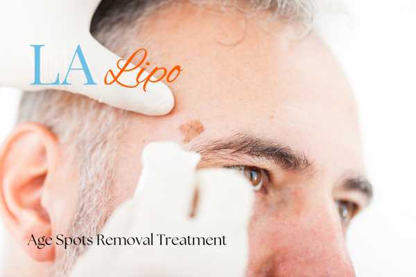 What Are the Most Effective Treatments for Age Spots Norbiton?