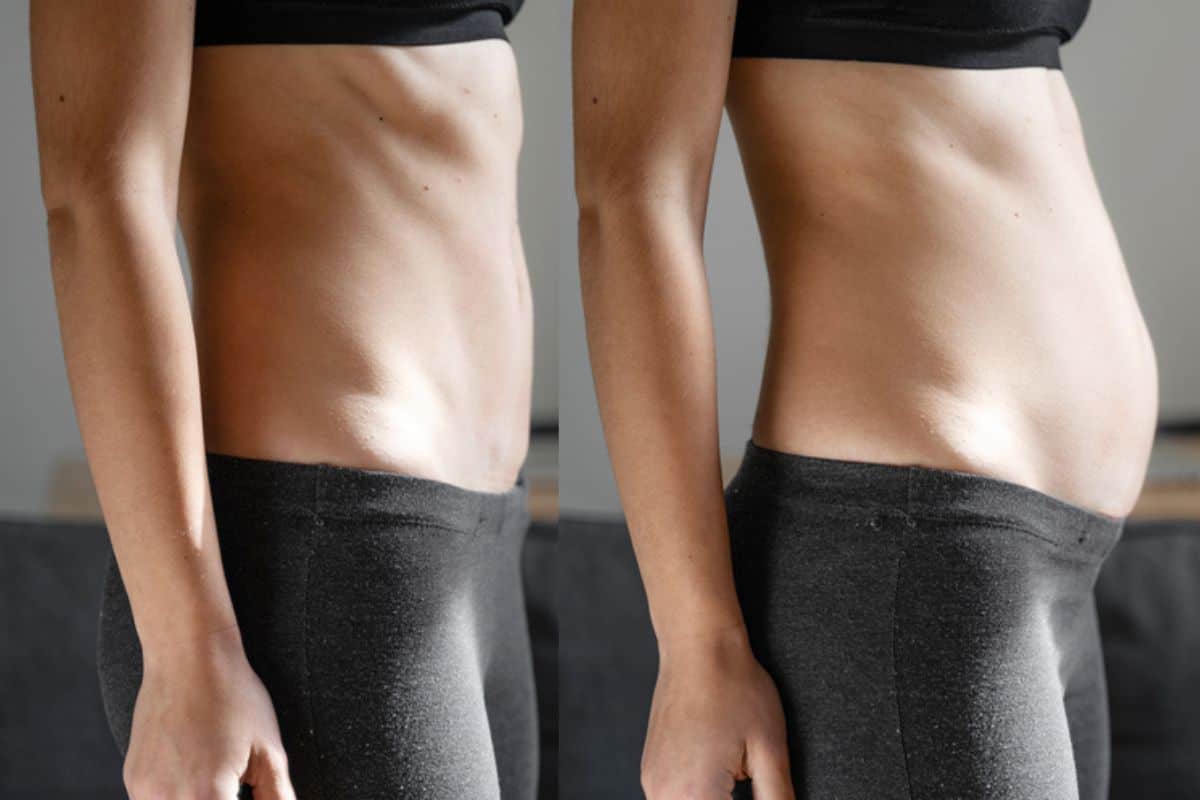 How long does diastasis recti take to improve Norbiton?