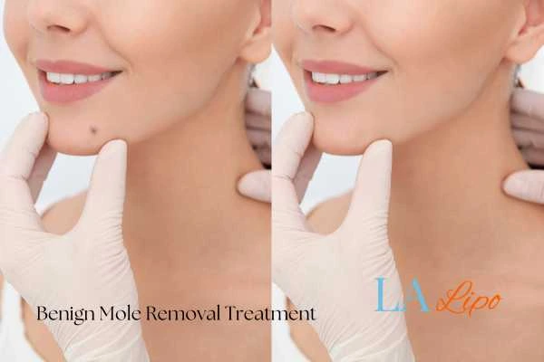 woman's before and after mole removal Norbiton results