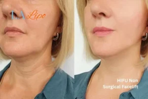 hi-fu for wrinkles Norbiton before and after results