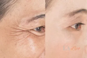 Before and after results of woman - HI-fu wrinkles reduction treatment Norbiton