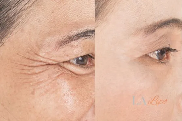 Before and after results of woman - HI-fu wrinkles reduction treatment Norbiton