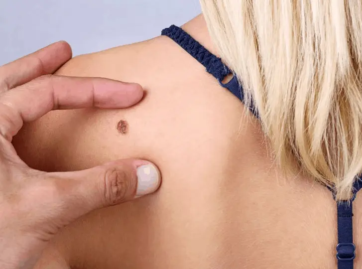 woman having mole removal Norbiton consultation before treatment.