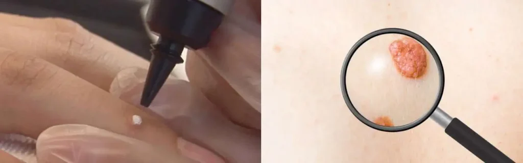 Cryopen for mole removal Norbiton - speak to our team today!