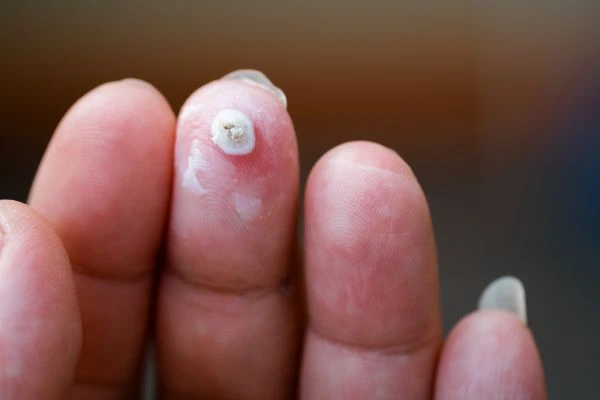 wart on person finger - cryotherapy to treat from LA LIPO Norbiton