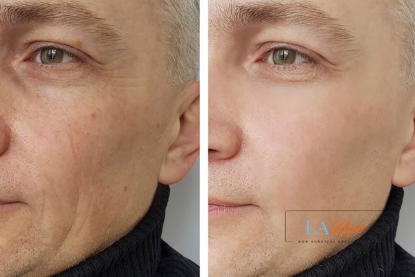 See the amazing results of Morpheus8 Treatment Norbiton!