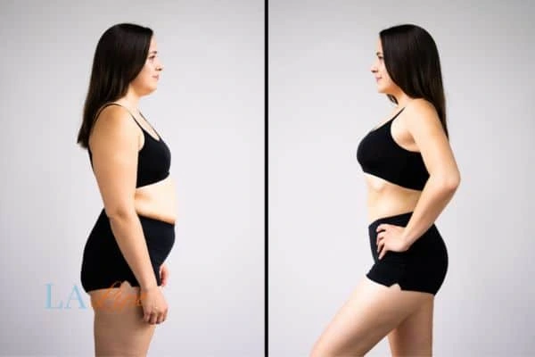 Picture of womans before and after using LA-EMS body sculpting to improve her core strength Norbiton