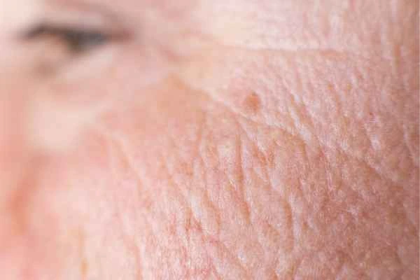 close up picture of a woman's face showing an age spot Norbiton