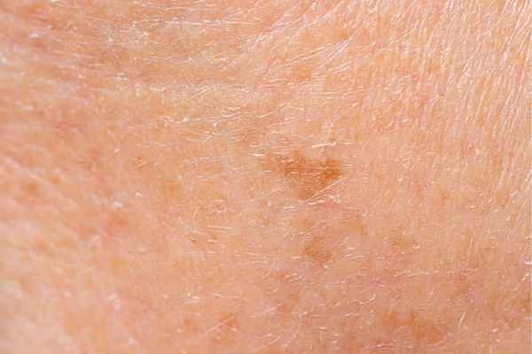 close up picture of age spots Norbiton