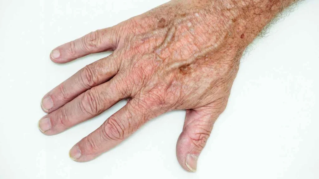 Male hand showing age spot Norbiton