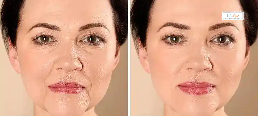 How Long Does It Take to See Results and How Long Do They Last Norbiton?