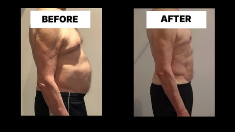 What Symptoms Can Diastasis Recti Cause in Men? Weak Core, Back Pain and Poor Posture Norbiton